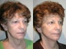 Sluplift Mini-Neck & Jowl Lift