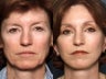 Facelift