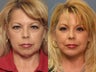 Facelift