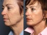 Facelift