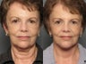Facelift