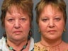 Facelift