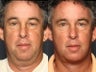 Facelift