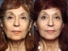 Facelift