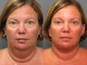 Facelift