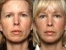 Facelift