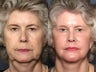 Facelift