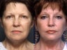 Facelift