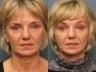 Facelift
