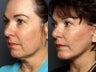 Facelift