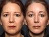Facelift