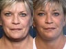 Facelift