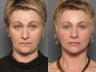 Facelift