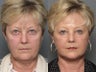 Facelift