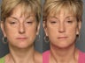 Face Lift Surgery