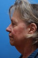 Face & Neck Lift