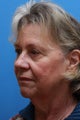 Facelift with Facial Fat Transfer