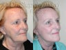 Sluplift Mini Neck & Jowl Lift & Lower Blepharoplasty