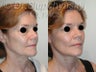 SLUPlift Neck & Jowl Lift