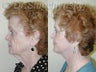 SLUPlift Neck & Jowl Lift
