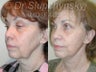 SLUPlift Neck & Jowl Lift