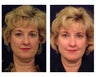 Full Facial Rejuvenation