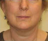 Face Lift