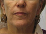 Face Lift, Fat grafrting, TCA Peel