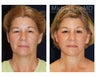 Facial Rejuvenation
