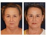 Facial Rejuvenation