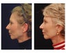 Facial Rejuvenation