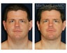 Facial Rejuvenation