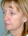 FaceLift