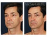 Facial Rejuvenation - Eyelid Surgery