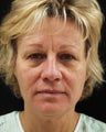facelift, forehead lift, blepharoplasty