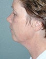 FaceLift
