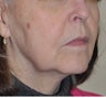Facelift