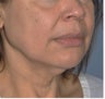 Facelift