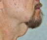 Direct Necklift