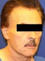Facelift Surgery
