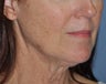 Facelift