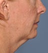 Facelift