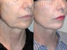 Sluplift- Mini Neck & Jowl Lift