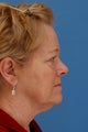 Face & Neck Lift, Facial Fat Grafting, Upper and Lower Eyelid Lifts, Perioral Dermabrasion