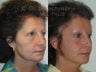Sluplift Neck & Jowl Lift and Upper Blepharoplasty