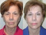 Sluplift Neck & Jowl Lift, Upper and Lower Blepharoplasty