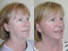 Sluplift- Mini Neck & Jowl Lift