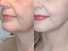 Sluplift- Mini Neck & Jowl Lift