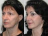 Endoscopic Brow Lift, Sluplift Neck & Jowl Lift & Lower Blepharoplasty