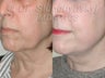 Sluplift- Mini Neck & Jowl Lift
